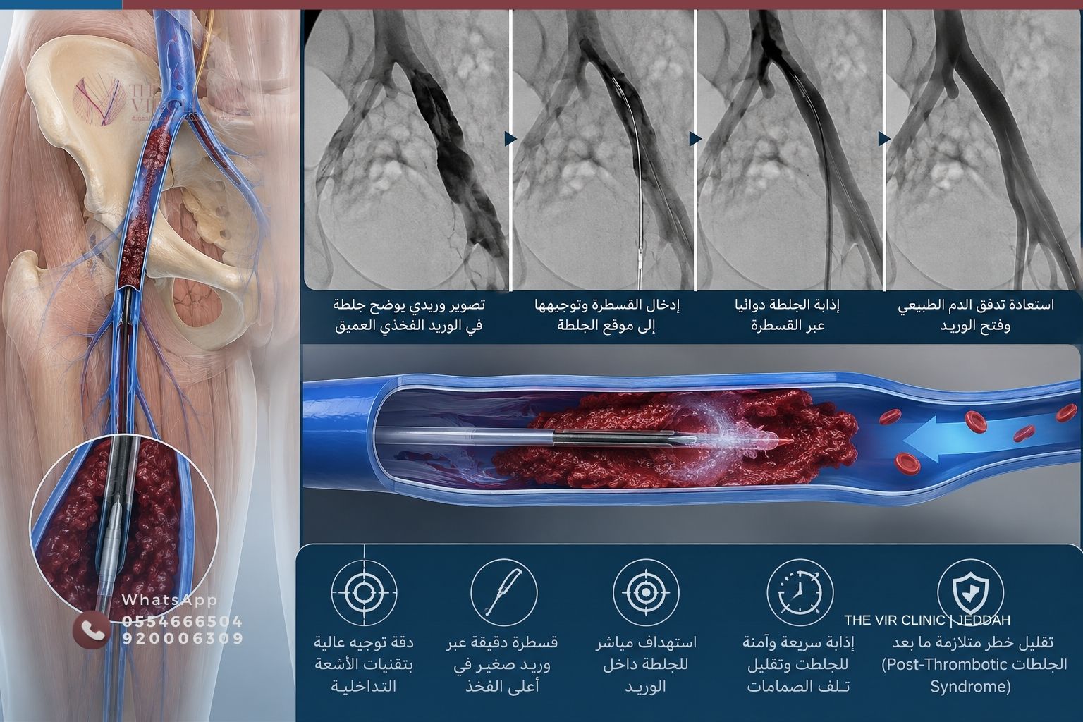 Read more about the article علاج تجلط الأوردة العميقة بالقسطرة: إذابة الجلطات ومنع المضاعفات بدون جراحة
